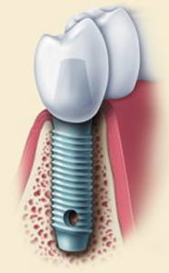 Dental Implant Illustration