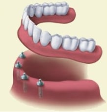 Implant Illustration