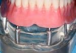 Implant overdenture model