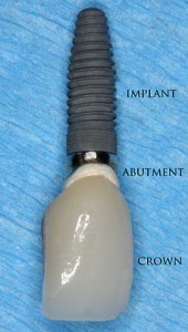 Dental Implant Illustration