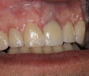 After Veneer