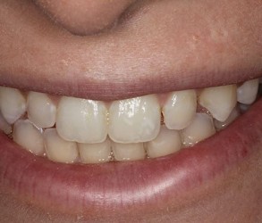 Before Veneers