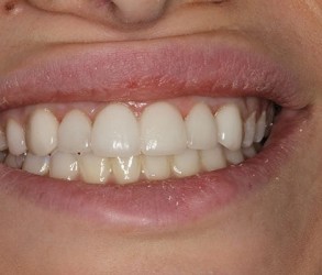 After Veneers