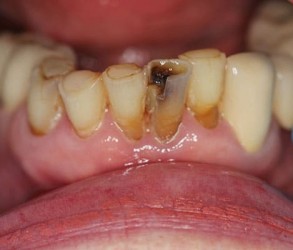 Before Lower Crowns