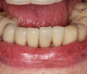 After Lower Crowns