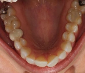 Top Teeth Before Invisalign