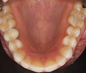Top Teeth After Invisalign