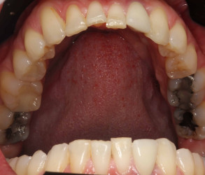 Lower Teeth Before Invisalign