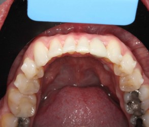 Lower Teeth After Invisalign