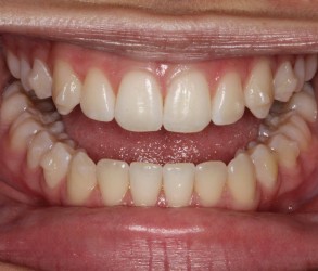 Full mouth After Invisalign