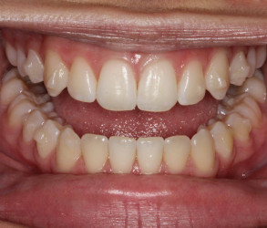 Full mouth After Invisalign