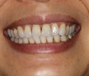 KoR Whitening Before