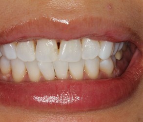 KoR Whitening After