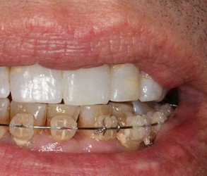 KoR on upper teeth