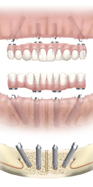 Teeth In a Day Illustration